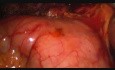 Exploration laparoscopique du canal cholédoque et drainage avec un tube T 