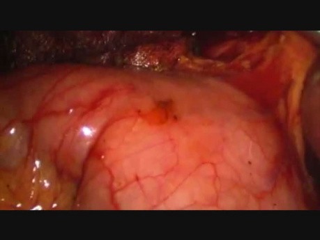 Exploration laparoscopique du canal cholédoque et drainage avec un tube T 