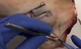 Chirurgie de Cancer Cutané - Le Lambeau Rhomboïde