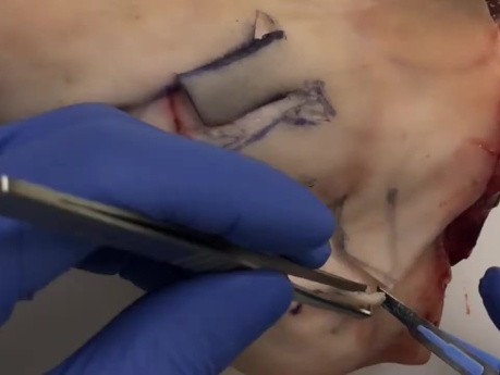 Chirurgie de Cancer Cutané - Le Lambeau Rhomboïde