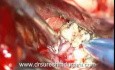 Tumeur de la Base du Crâne - Méningiome de la Selle Turcique - Ablation Microchirurgicale
