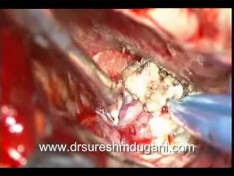 Tumeur de la Base du Crâne - Méningiome de la Selle Turcique - Ablation Microchirurgicale