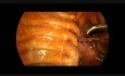 Résection Thoracoscopique de l'Apex du Poumon dans la prise en charge du Pneumothorax Spontané