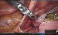 Duodénojéjunostomie Entièrement Eobotisée pour le Syndrome de l'Artère Mésentérique Supérieure