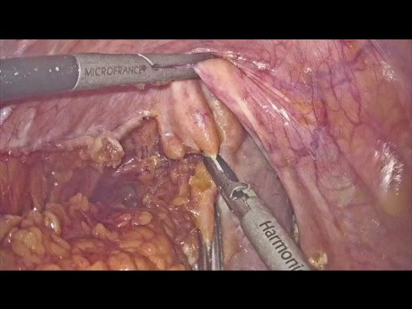 Résection rectale laparoscopique.