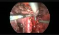 Hystérectomie laparoscopique totale et lymphadénectomie pelvienne