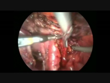 Hystérectomie laparoscopique totale et lymphadénectomie pelvienne
