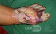 Une infection du pied avec nécrose partielle des tissus.