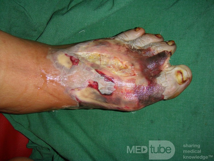 Une infection du pied avec nécrose partielle des tissus.