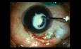 Chirurgie de la cataracte chez l'enfant