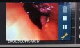Bronchoplastie par chirurgie thoracique robot-assistée - Tumeur de la bronche principale gauche
