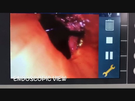 Bronchoplastie par chirurgie thoracique robot-assistée - Tumeur de la bronche principale gauche