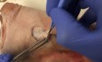 Chirurgie du Cancer de la Peau - Lambeau Bilobé