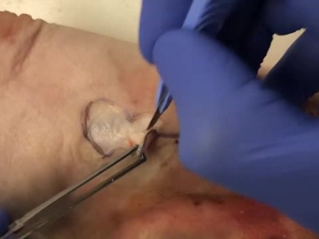 Chirurgie du Cancer de la Peau - Lambeau Bilobé