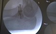 Chirurgie Intra-Articulaire de la Fracture de la Tête Radiale 