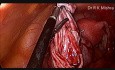 Ablation d'un kyste ovarien par voie cœlioscopique