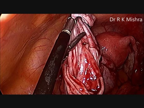 Ablation d'un kyste ovarien par voie cœlioscopique