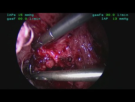Retrait laparoscopique du filet avec reconstruction d'œsophage