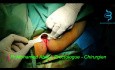 Fissure Anale Laser