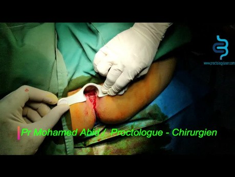 Fissure Anale Laser