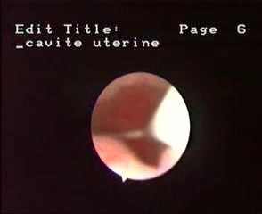 Aspect Hystéroscopique du Dispositif Intra-Utérin (DIU)