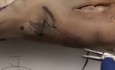 Chirurgie du Cancer de la Peau " Plastie en Z"