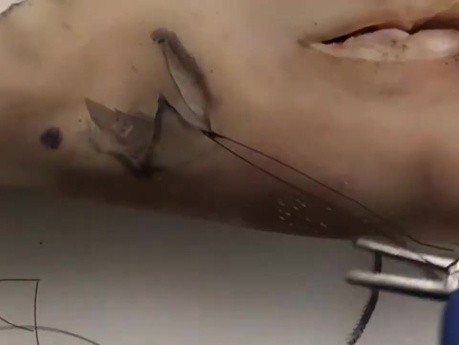 Chirurgie du Cancer de la Peau " Plastie en Z"