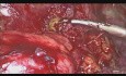 Prise en charge par laparoscopie d'une fistule colo-cutanée et une fistule colo-vaginale due à une diverticulose sigmoïdienne compliquée
