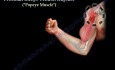 Rupture proximale du tendon du biceps brachial