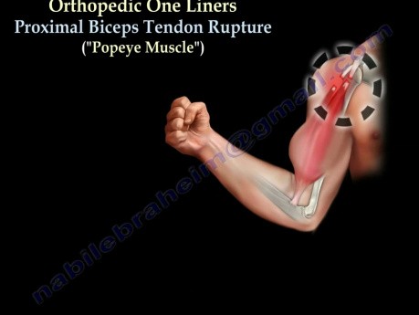 Rupture proximale du tendon du biceps brachial