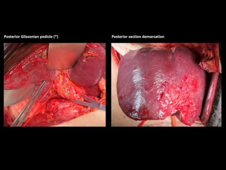 Segmentectomie Postérieure Droite Avec Résection De La Veine Hépatique Droite Pour Métastases De Cancer Du Côlon - Présentation De Cas