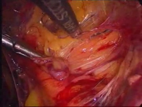Hernioplastie laparoscopique bilatérale inguinale en maille TEP