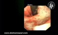 Vue Endoscopique : Grande Hernie Hiatale