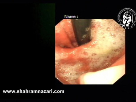 Vue Endoscopique : Grande Hernie Hiatale