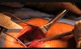 Prothèse de hanche antérieure mini-invasive (type Huerter-Judet) par le Dr Marc Fischer