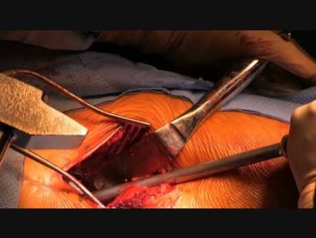 Prothèse de hanche antérieure mini-invasive (type Huerter-Judet) par le Dr Marc Fischer