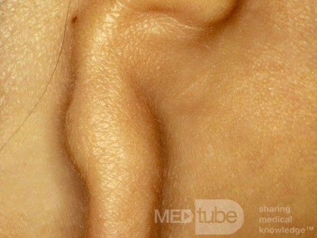 Microtie de l'oreille [à droite]