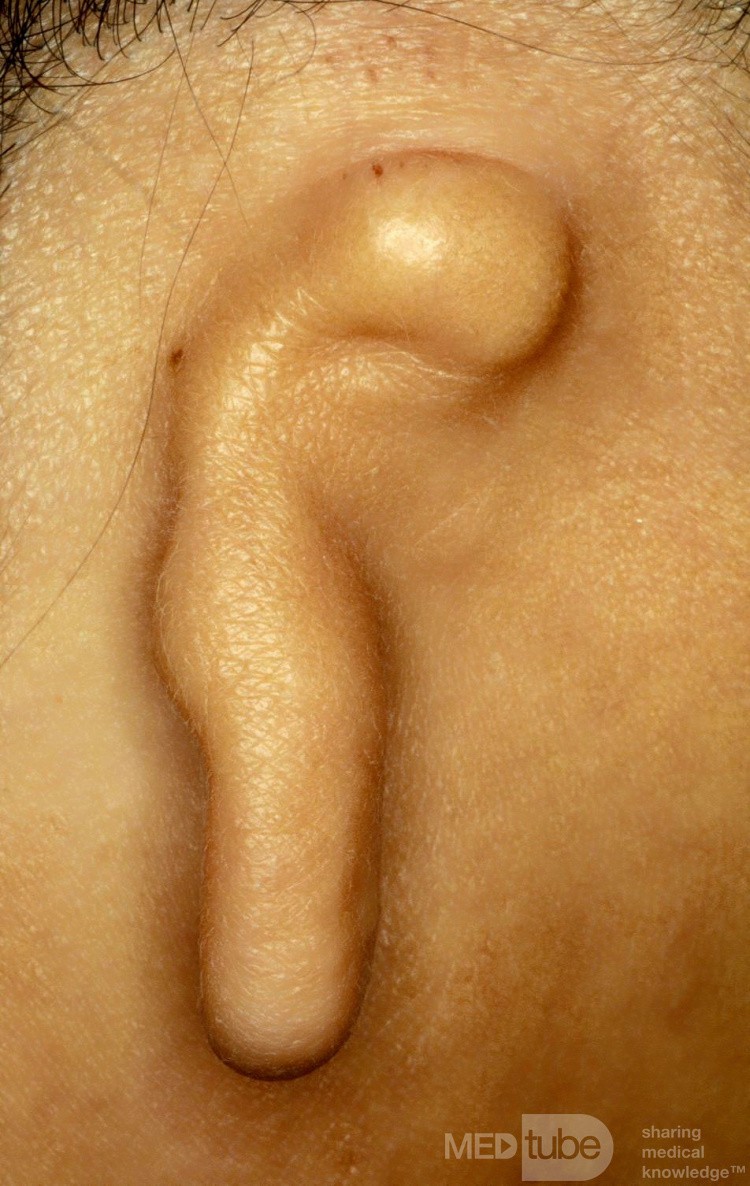 Microtie de l'oreille [à droite]