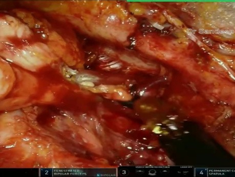 Voie Sous-Claviculaire Robotisée : Dissection Cervicale Mini-Invasive dans les Cancers de la Tête et du Cou