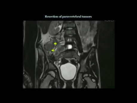 Chirurgie du schwannome malin