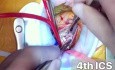 Triple Valve Surgery + CABG via LAT