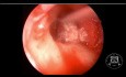 Résection du cholestéatome par approche endoscopique et microscopique