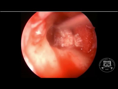 Résection du cholestéatome par approche endoscopique et microscopique