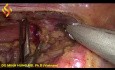Œsophagectomie Thoraco-Laparoscopique - Partie Thoracique 3