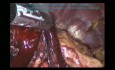 Gastrectomie totale par voie laparoscopique à cause du cancer de l'estomac 