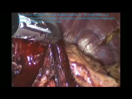 Gastrectomie totale par voie laparoscopique à cause du cancer de l'estomac 