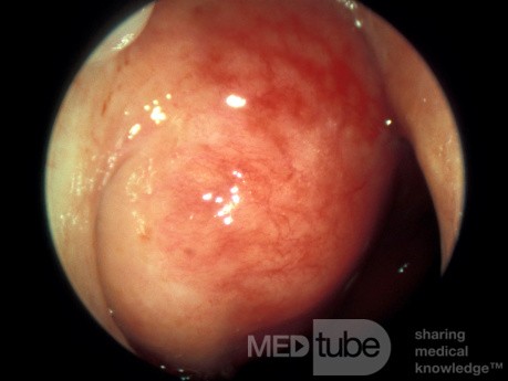 Carcinome du nasopharynx