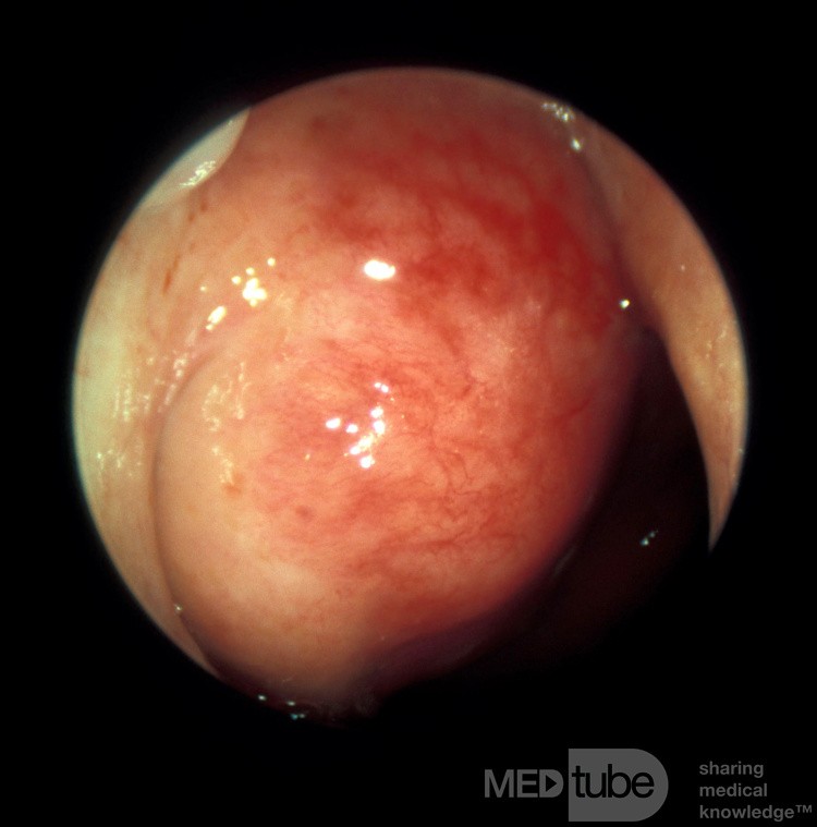 Carcinome du nasopharynx