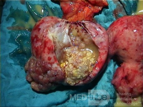 Tumeur maligne de l'ovaire- chirurgie radicale, 2
