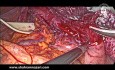 Myotomie Longue pour Achalasie
